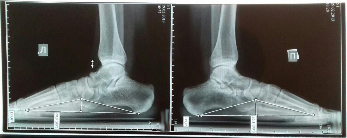 Как правильно делать рентген стоп. Продольное плоскостопие рентген. Продольное плоскостопие рентген степени. Поперечно-продольное плоскостопие рентген степени. Поперечное плоскостопие рентген.