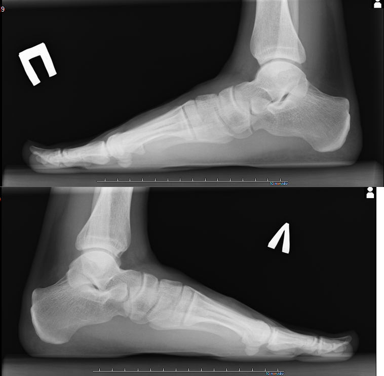 Плоскостопие рентген. Рентген стопы плоскостопие. Рентген стоп на продольное плоскостопие. Рентген степи плоскостопии. Рентген стопы плоскостопие 3.
