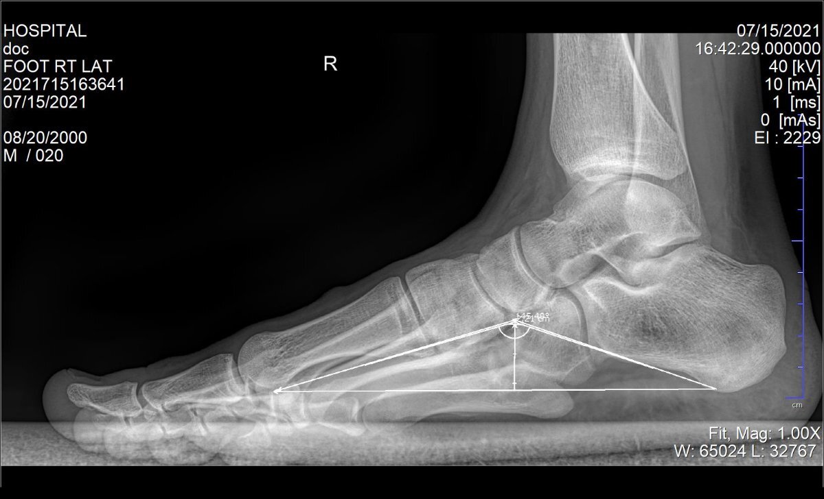 Поперечное плоскостопие 2 степени. Как правильно сделать рентген стопы для военкомата.